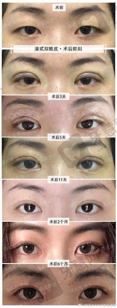 福州莳肌医疗美容诊所双眼近视矫正实例