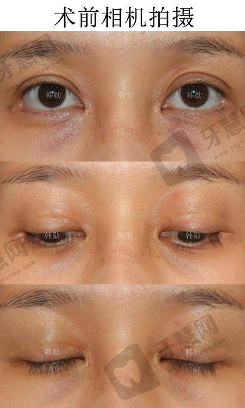 福州莳肌医疗美容诊所溶解酶注射的注意事项