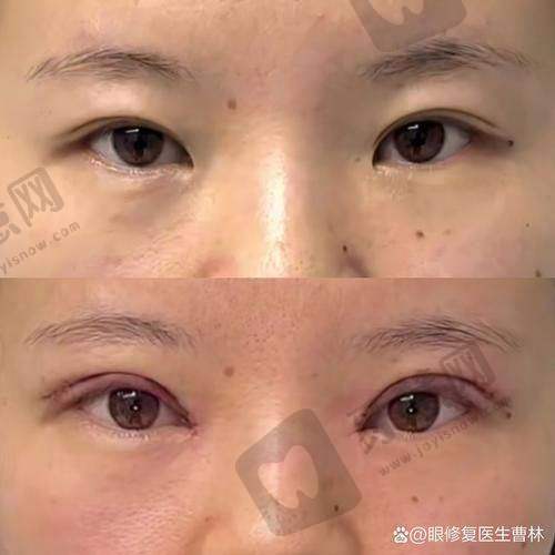 福州莳肌医疗美容诊所溶解酶的成效令人惊喜