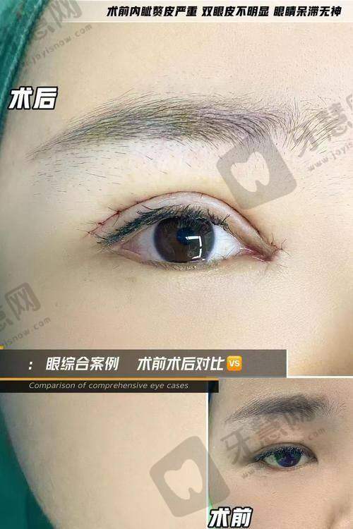 贾思源医生:眼睑下垂矫正骨干医生