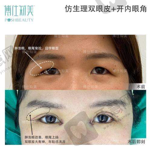 张思华医生:眼部年轻化整形具有影响力