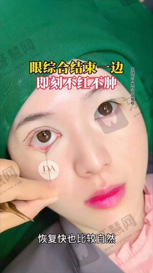 阮庆玲医生:双眼皮整形艺术大师