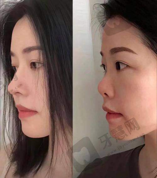 彭鑫医生做鼻子怎么样？个性化设计搭配精细化操作，塑造自然协调美鼻