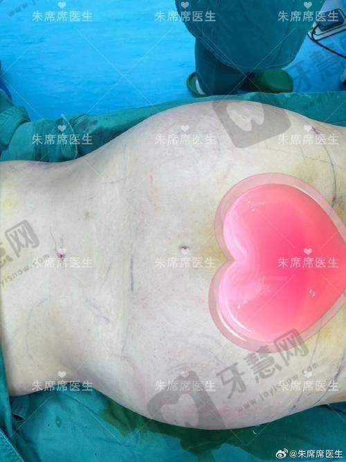 福州莳肌医疗美容诊所脂肪填充价格与城市对比
