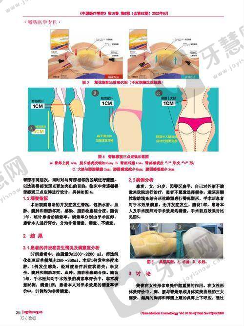 福州莳肌医疗美容诊所肉毒素瘦身成效实例
