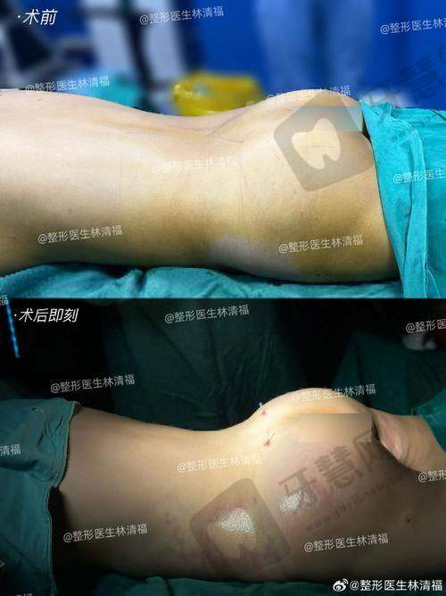 福州莳肌医疗美容诊所不同部位脂肪填充价格差异