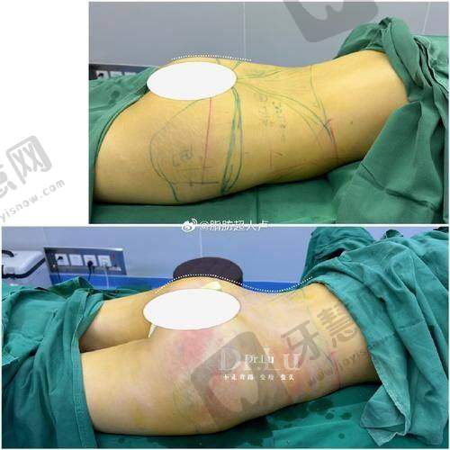 福州莳肌医疗美容诊所做射频溶脂多少钱之价格趋势预测