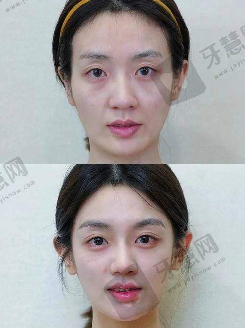 深圳安美聚光医疗美容门诊部玻尿酸填充面颊多少钱？面部填充5000元起，顾客好评效果自然