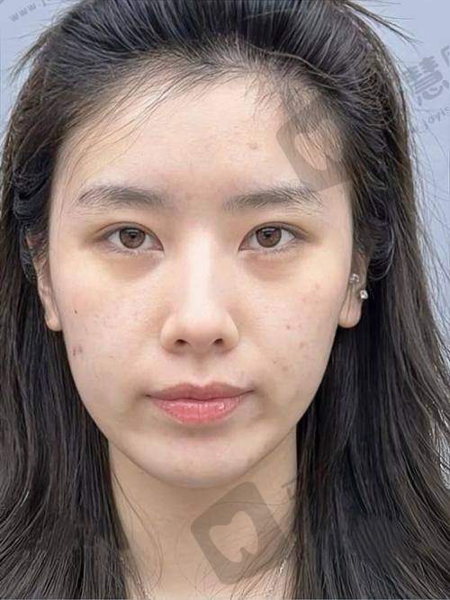 深圳安美聚光医疗美容门诊部玻尿酸填充面颊顾客好评