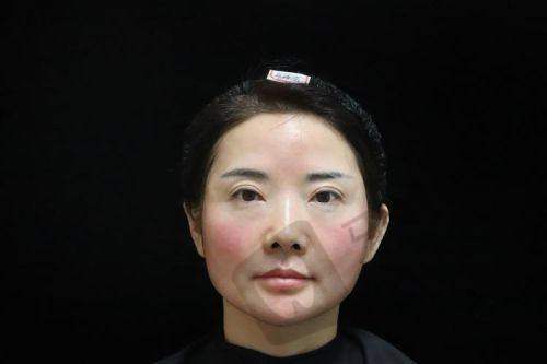 深圳安美聚光医疗美容门诊部玻尿酸填充面颊价格影响因素