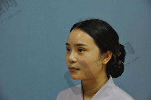 福州莳肌医疗美容诊所玻尿酸去法令纹手术哪位专家好？安利陈曦医生，操作便捷恢复期短！