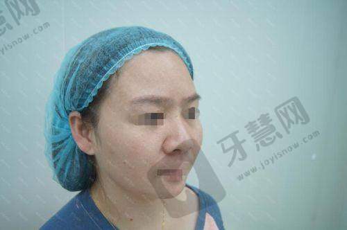 福州莳肌医疗美容诊所玻尿酸去法令纹手术的价格分析