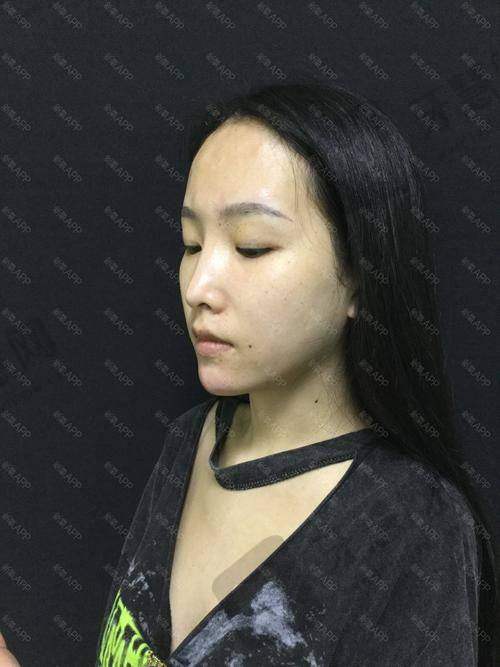 深圳安美聚光医疗美容门诊部玻尿酸垫下巴价格与其他医院对比