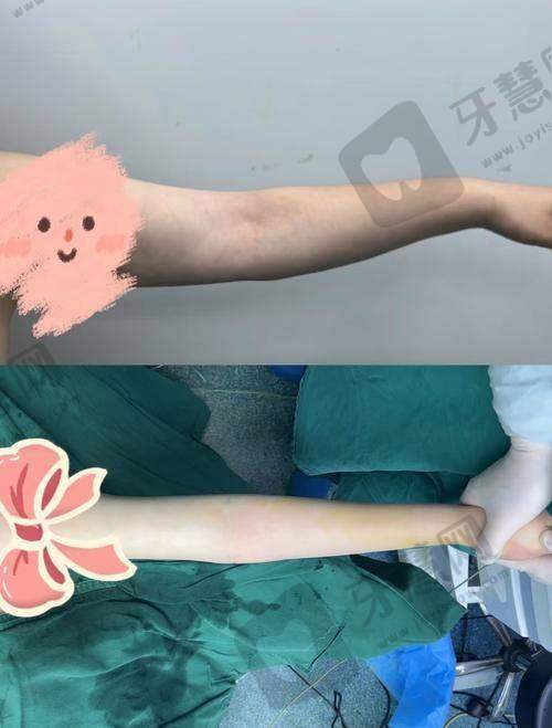 福州莳肌医疗美容诊所肉毒素瘦身价格分析