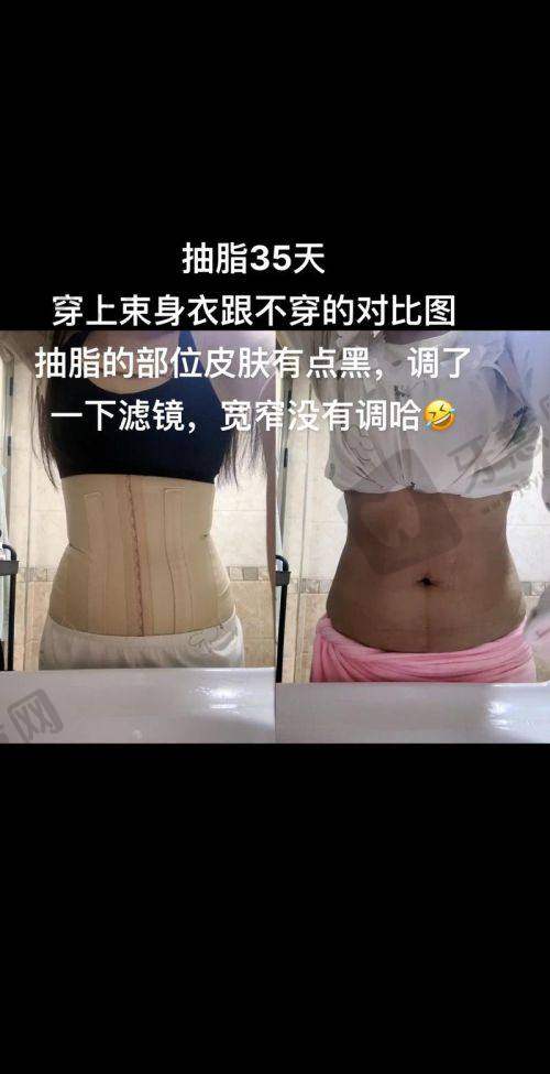 北京市吸脂瘦腹部总结