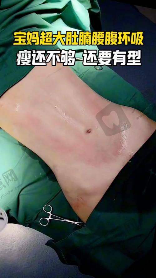 北京市吸脂瘦腹部医院医生项目介绍