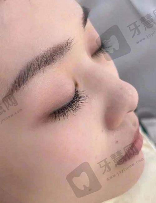 北京市接睫毛手术费用大概是多少钱?100 - 5000元区间受多因素影响全解析