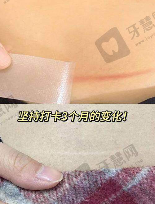 福州美莱华美疤痕软化祛疤项目特色