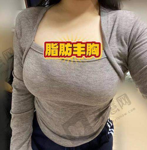 福州莳肌医疗美容诊所自体脂肪填充泪沟的优势体现