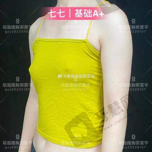 福州莳肌医疗美容诊所自体脂肪填充实例分享