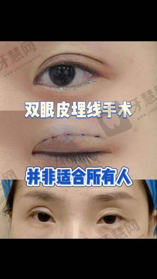福州莳肌医疗美容诊所冰点脱毛项目
