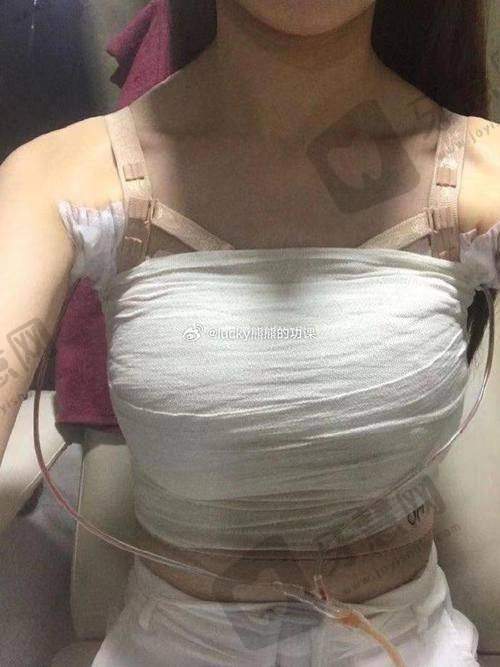 北京隆胸医生高鹏怎么样?圣嘉丽高鹏擅隆胸,薇琳高鹏精雕面部轮廓