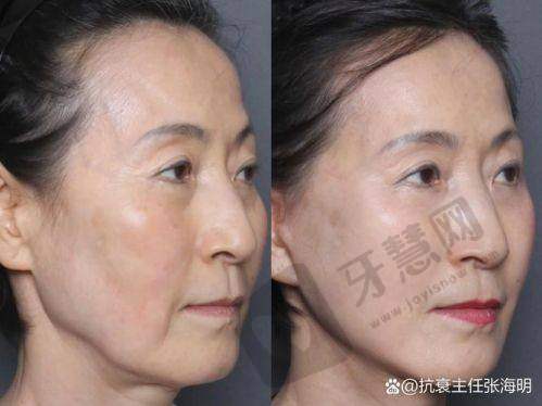 深圳安美聚光医疗美容门诊部自体脂肪填充全脸价格与其他医院对比