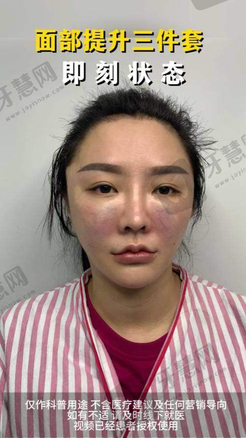福州莳肌医疗美容诊所注射去面部细纹之顾客好评