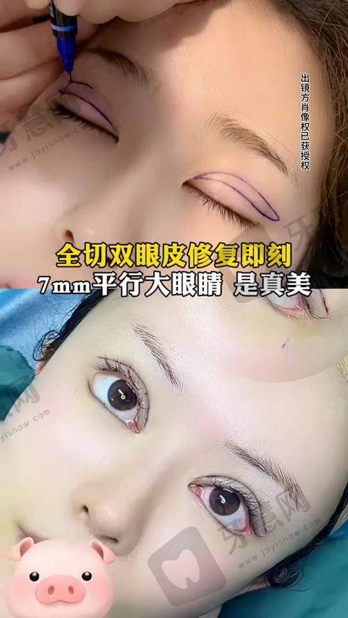 福州莳肌医疗美容诊所双眼近视矫正特色