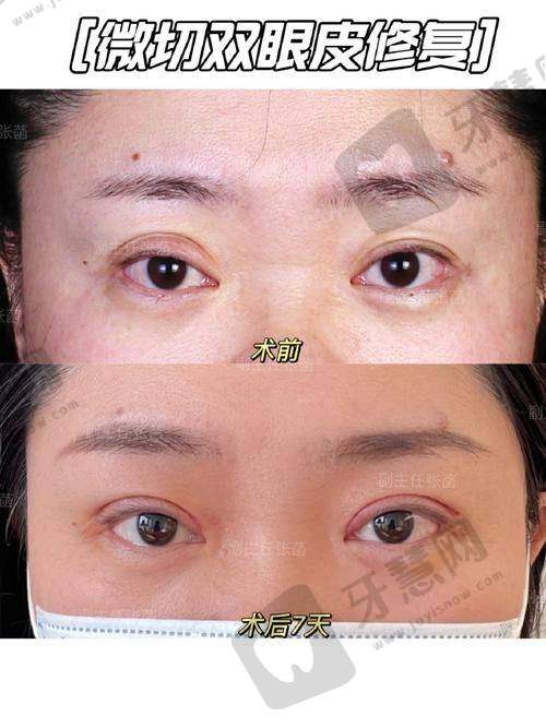 福州莳肌医疗美容诊所唇腭裂修复术情况