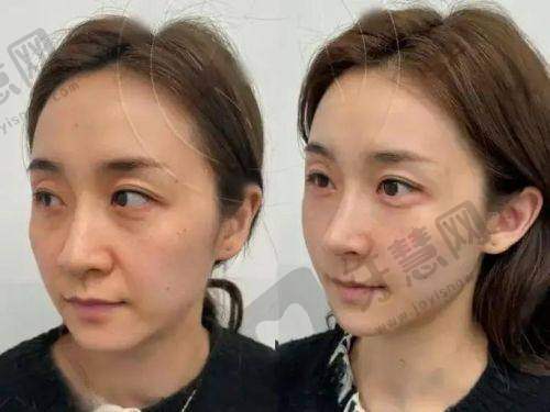 伊维兰5D童颜针与玻尿酸对比怎么样