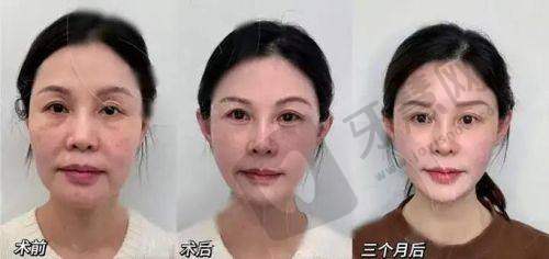 影响伊维兰玻尿酸维持时间的因素怎么样