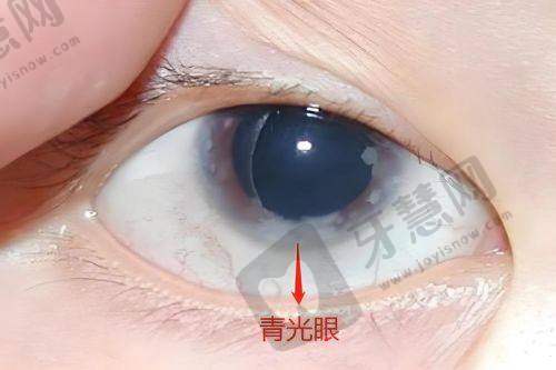 内江爱尔眼科医院价格表