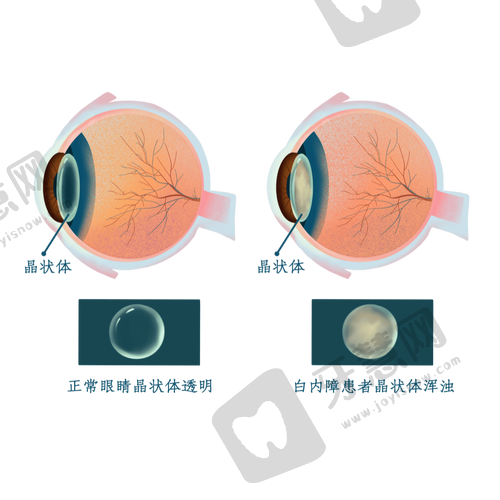 青岛鲁东眼科医院莱西眼科中 心——白内障与近视矫正的实力担当