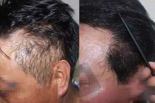 盐城森海植发医院真实口碑：患者亲述的优质体验