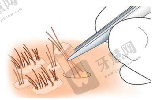 盐城森海植发医院项目特色：脱发治疗与美学种植的理想结合