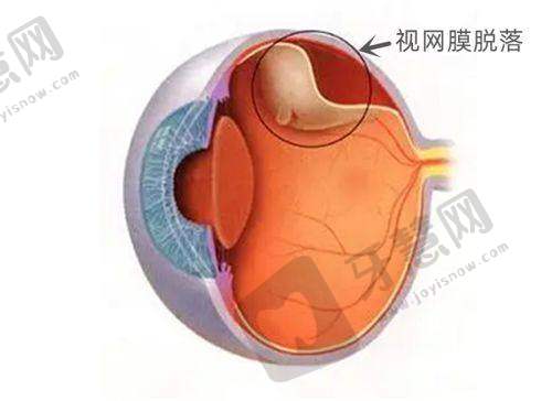 爱尔眼科医院人工晶体定期复查的意义