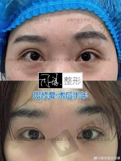 三、无锡坤如玛丽张凡医生做双眼皮手术多少钱