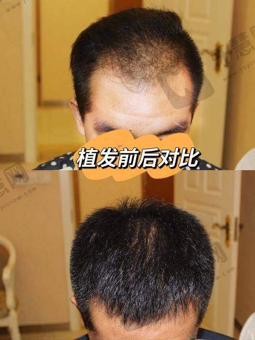 盐城森海植发医院医生团队：专精不错，经验多