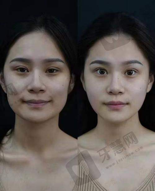 三、刘晓玉医生做完手术的体验如何