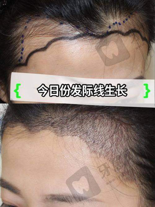 大麦微针植发多少钱一个毛囊?2025最新价10-60元/单位(重庆|深圳|上海技术差异影响报价)