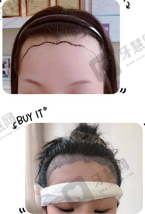 深圳悦尔医美植发专科医院正规吗?