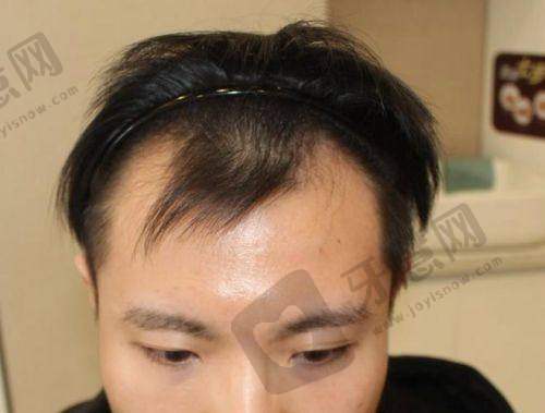 深圳倍生植发医院价格表