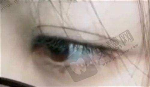 北京米兰柏羽丽都医疗美容王娟医生眼部多项手术价格
