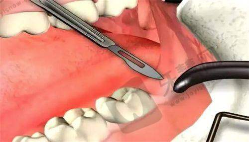 二、蒲杨磊医生手术费用详情