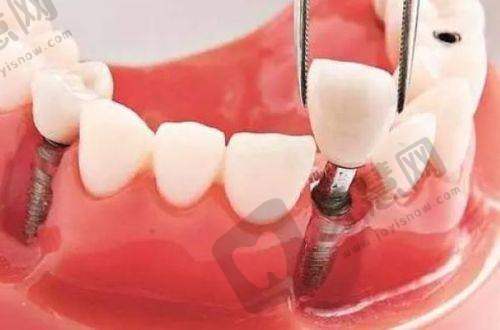 杜欣烨医生手术费用