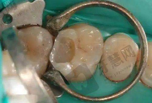 张建朋医生手术费用:不同项目价格有别