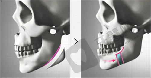深圳有名的隆胸医生排名之陈星光
