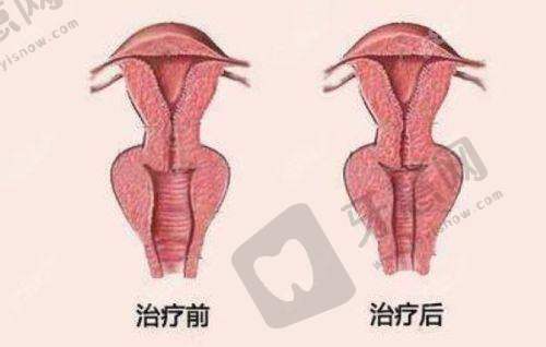南京双眼皮手术价格参考