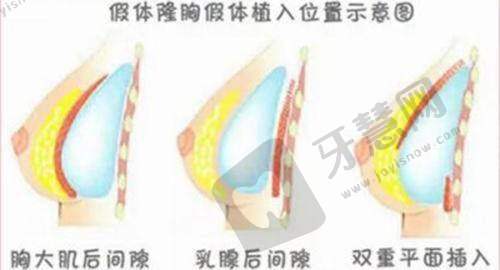 如何选择适合自己的吸脂医院